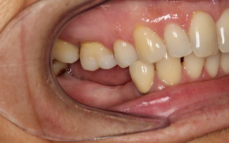 rụng răng gây ảnh hưởng đến các răng khác