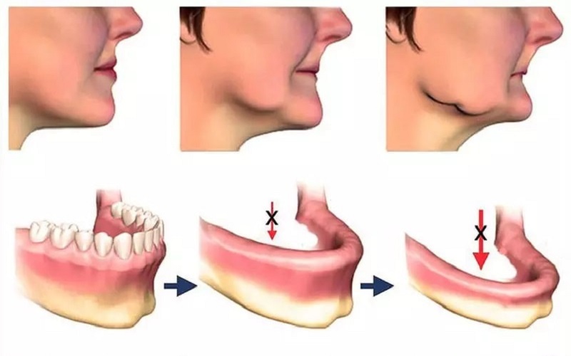 rụng răng gây tiêu xương quai hàm